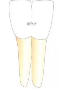 两个牙长在一起并融合了怎么办,两颗牙长在一起