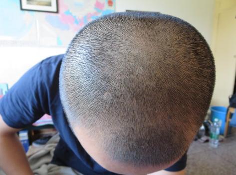 治疗脂溢性脱发的药,一招解决脂溢性脱发