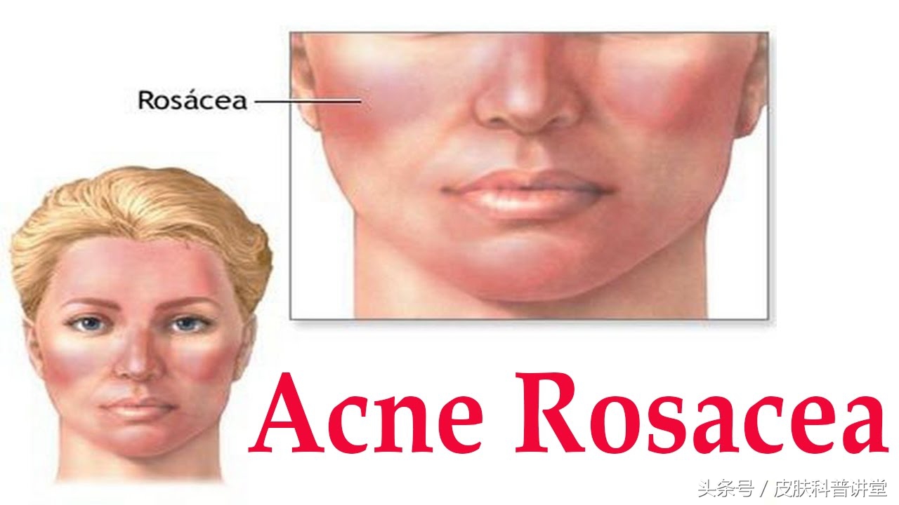 酒渣鼻玫瑰痤疮是怎么引起的,玫瑰痤疮会变成酒渣鼻吗