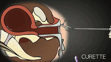 妇产科医生说反复人流的女人可加速衰老,看你还动不动就去人流不