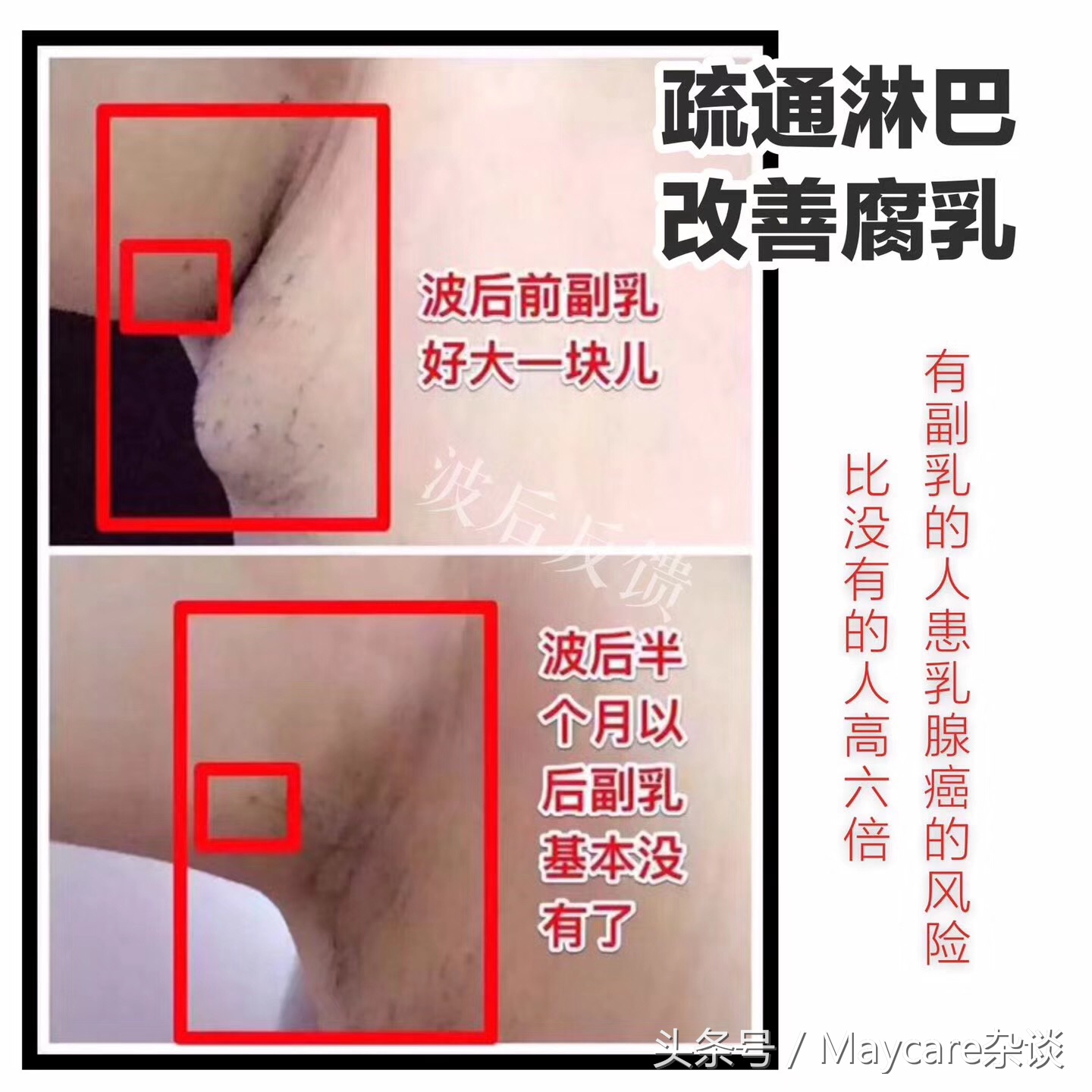 副乳腋下淋巴结堵塞,腋下淋巴结肿大活检危害