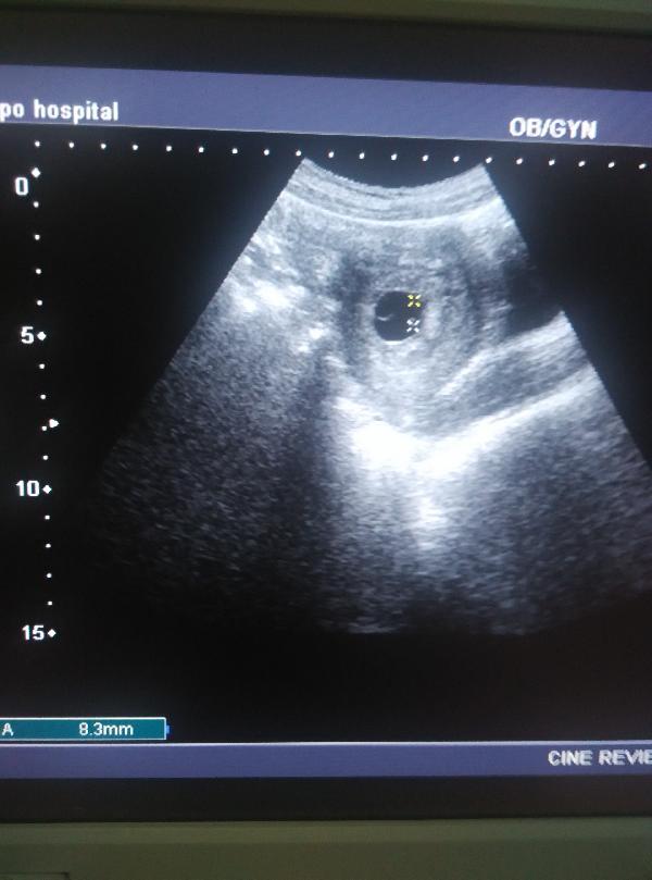 早孕做宫腔超声会不会流产,怀孕流产超声能看出来吗