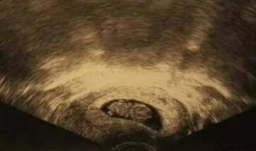 怀孕了不知道做了超声波有影响吗,怀孕了能做妇科超声吗