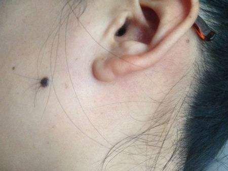 熬夜睡觉都睡得好会不会长痣,熬夜长痣的原因