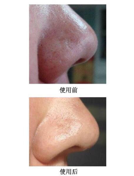 如何去黑头收缩毛孔最简单,怎么去黑头收缩毛孔小妙招