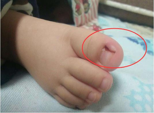 小月龄宝宝剪指甲甲沟炎,宝宝剪指甲出现甲沟炎怎么办