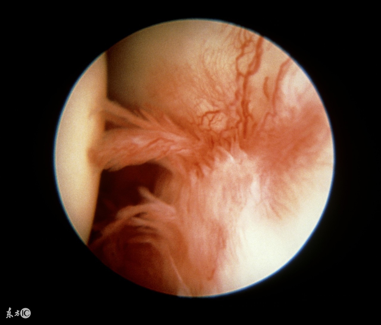 骨盆滑膜炎久治不愈,踝关节滑膜炎久治不愈怎么办