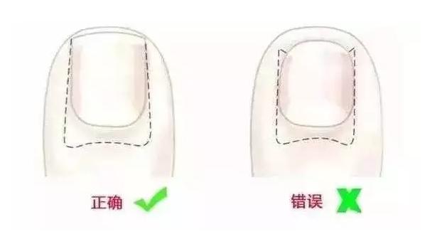 小月龄宝宝剪指甲甲沟炎,宝宝剪指甲出现甲沟炎怎么办