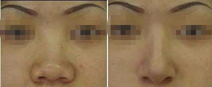 鼻子整形的方法有几种,鼻子整形方法都有哪些图片