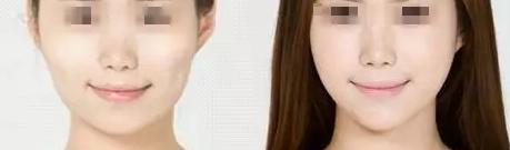 打了瘦脸针脸下垂怎么办,瘦脸针后脸下垂怎么办