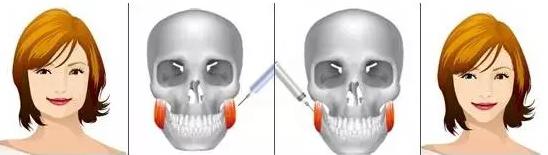 打了瘦脸针脸下垂怎么办,瘦脸针后脸下垂怎么办