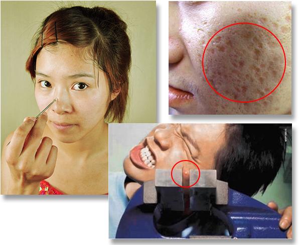 痘痘到底能不能治愈,痘痘到底能不能挤