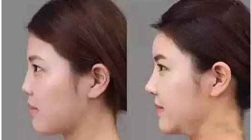 一张图让你全面了解鼻综合整形,鼻综合整形后鼻子一般多久消肿