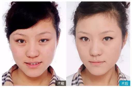 一次水光针1000张面膜6000次普通护肤