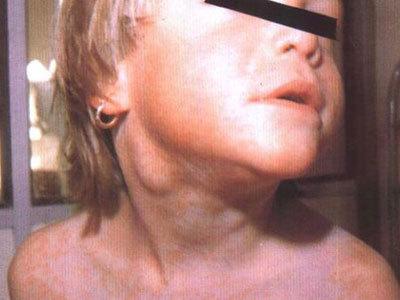 脖子肿大输液无法消退,脖子上有个疙瘩输消炎药变小