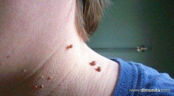 润大通林：扁平疣是不是病？