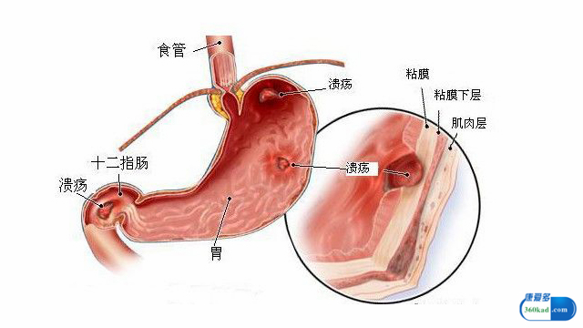 泮托拉唑钠肠溶胶囊的功效副作用,泮托拉唑钠肠溶片治胃溃疡用量