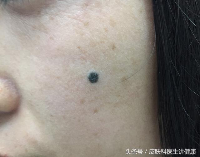 需要动手术才能切的痣有必要吗,医生建议切除的痣一定是不好的吗