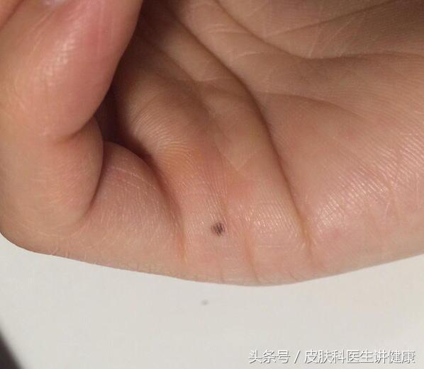 需要动手术才能切的痣有必要吗,医生建议切除的痣一定是不好的吗