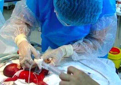 年轻妈妈产微型婴儿，花几十万也保不住，医生大怒：你们干的好事