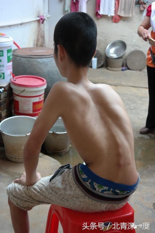 罕见病200万一年,不可治愈的罕见病有哪些