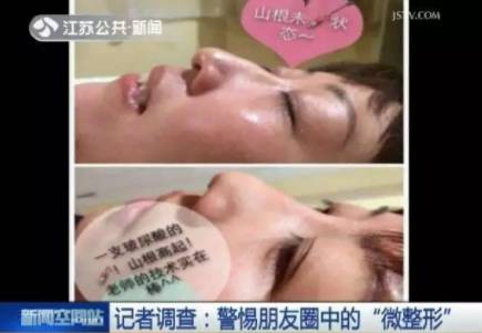 瘦脸针防止凹陷,瘦脸针注意避坑