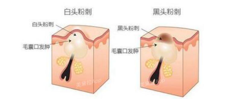 粉刺没有处理好变成硬疙瘩,痘痘粉刺消不掉