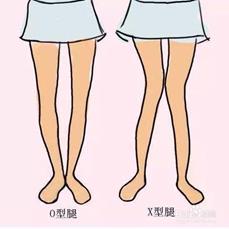 小腿粗如何改善走姿,两个小腿不一样粗怎么改善