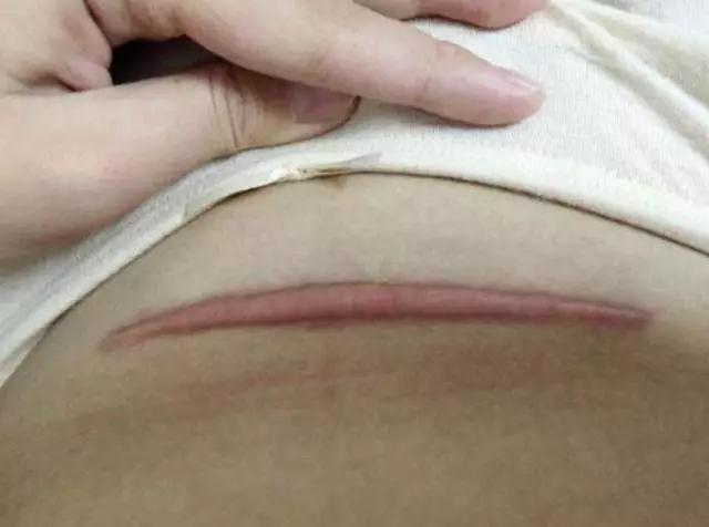 二胎剖腹产伤口恢复,剖腹产产妇17天伤口有点红