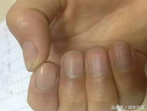 手指上没有半月牙是啥原因,手指半月牙代表什么