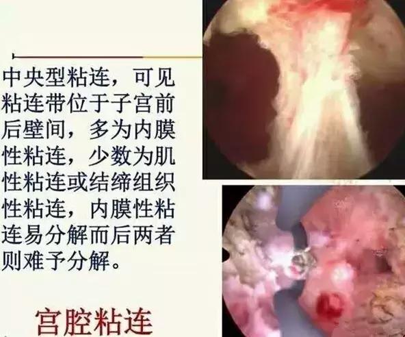 有哪些不良症状要做宫腔镜检查,一般什么情况才会做宫腔镜检查
