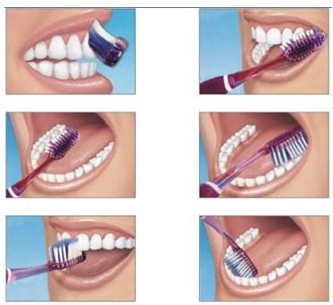 刷牙牙龈出血是因为上火,刷牙牙龈出血什么情况牙冠出问题