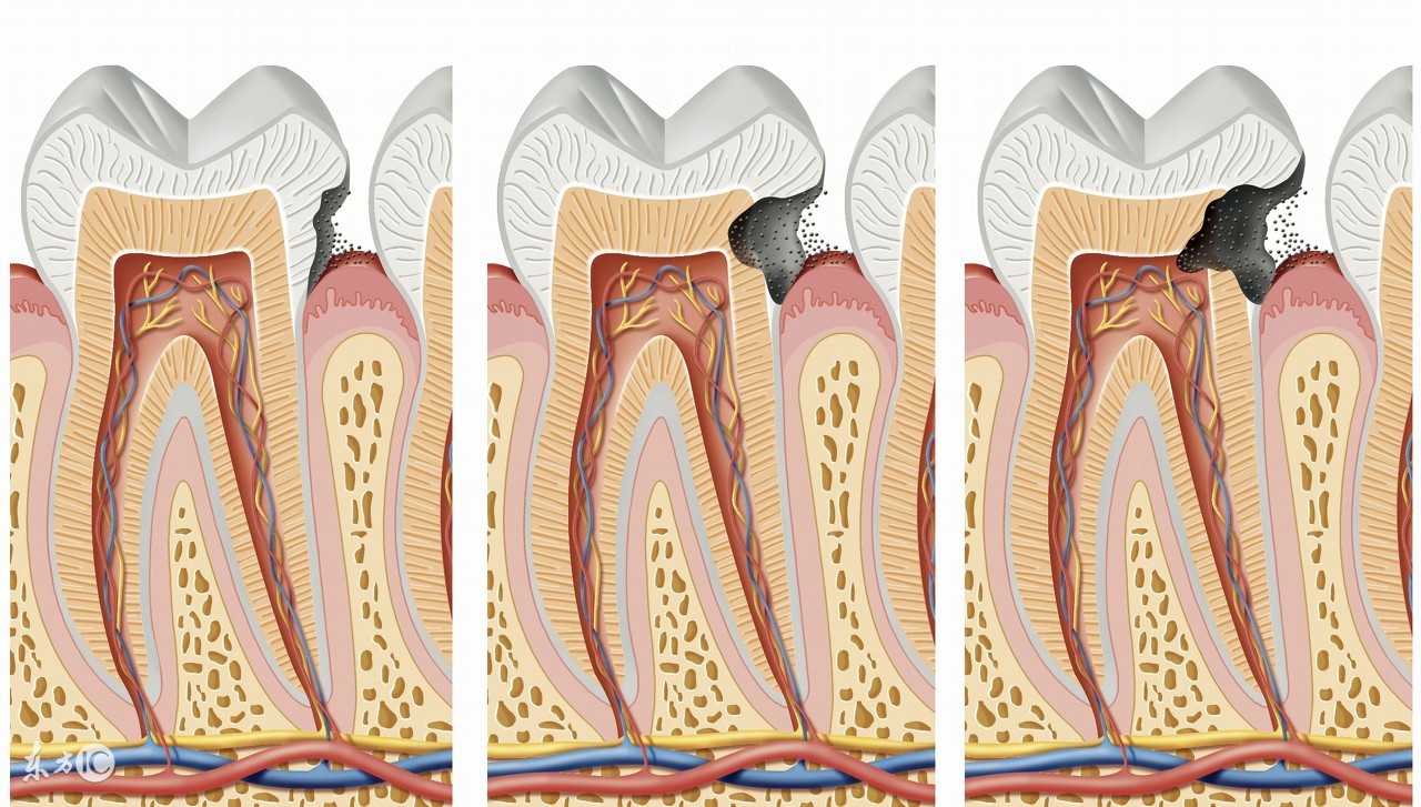 牙疼一会儿好一会儿疼,牙疼一会儿痛一会儿不痛怎么回事