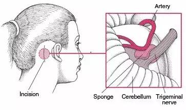 面瘫专家在线问诊,专家专治面瘫视频