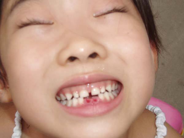 困扰20年的拔牙恐惧,如何克服对拔牙的恐惧感