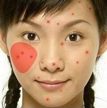 看图识别痘痘,看懂各种痘痘类型和应对方法