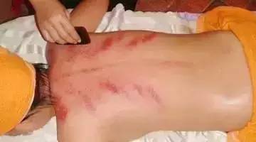 刮痧也可以减肥，做前你得要了解这些事，事半功倍