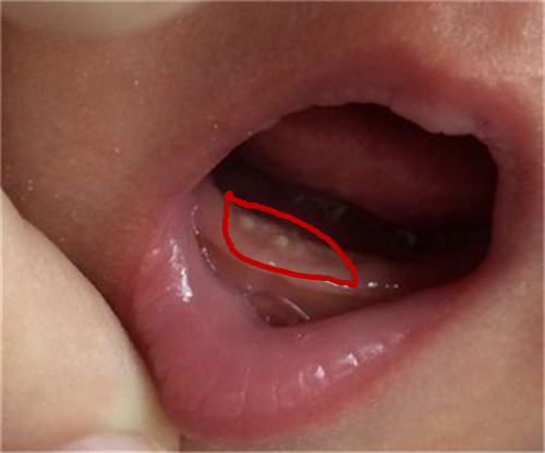 宝宝马牙该怎么处理,宝宝马牙处理方法