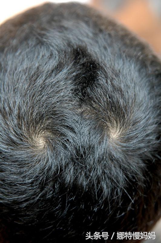 宝宝的头旋有什么说法吗,宝宝的头旋为啥是歪的