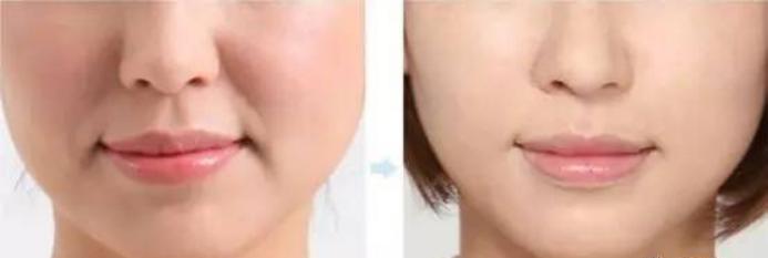 三十岁有法令纹可以做超声刀吗,做完脸部超声刀法令纹变明显了