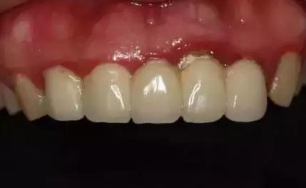 一周快速脸部美白小妙招,美容冠的形态怎么做的