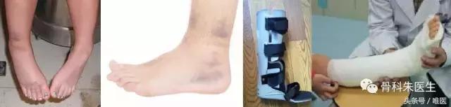 踝关节扭伤如何用药,踝关节扭伤后保守穿护踝有用吗