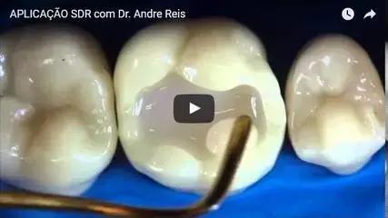 牙齿摔倒掉了一半补牙全过程,一颗牙齿脱落补牙