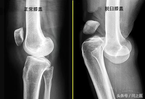 运动后膝盖疼痛的原因和解决方法,跑步后膝盖疼痛的原因和解决方法