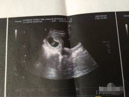 怀孕初期个人经验分享（特别是孕酮低的）