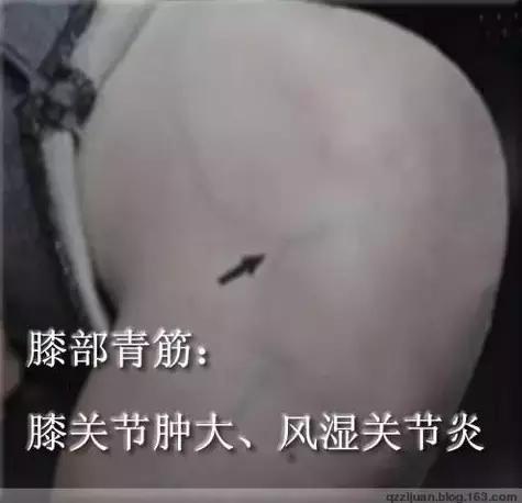 各类青筋的分布和原因,治爆青筋的中药方法