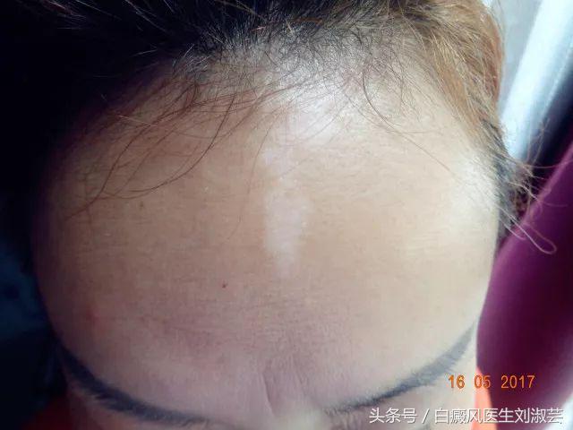白斑患者的真实生活,白斑患者自述