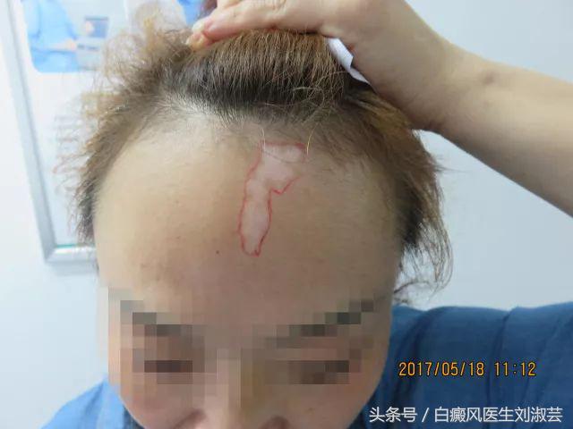 白斑病患者自述,白斑患者图片