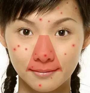 健康关注重点,哪些位置的痘不能随便乱挤