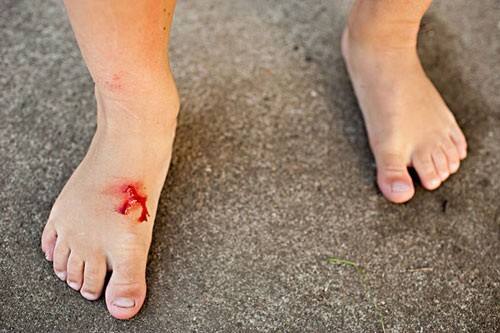 伤口旁边有一圈白色的是什么,伤口上面有白色的一层是什么